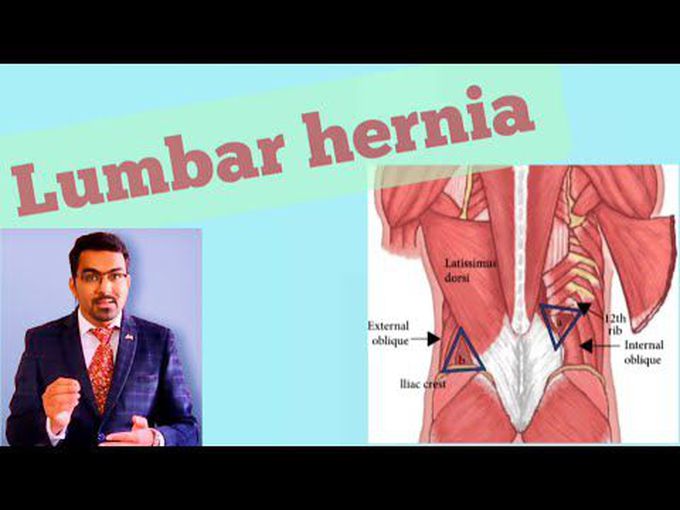 Lumbar Hernia: Slide Presentation