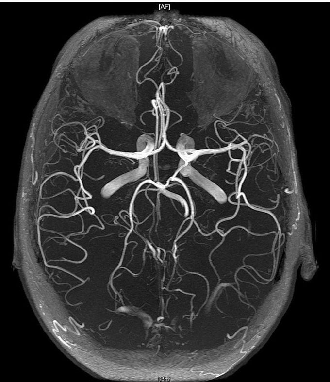 MRA of Brain