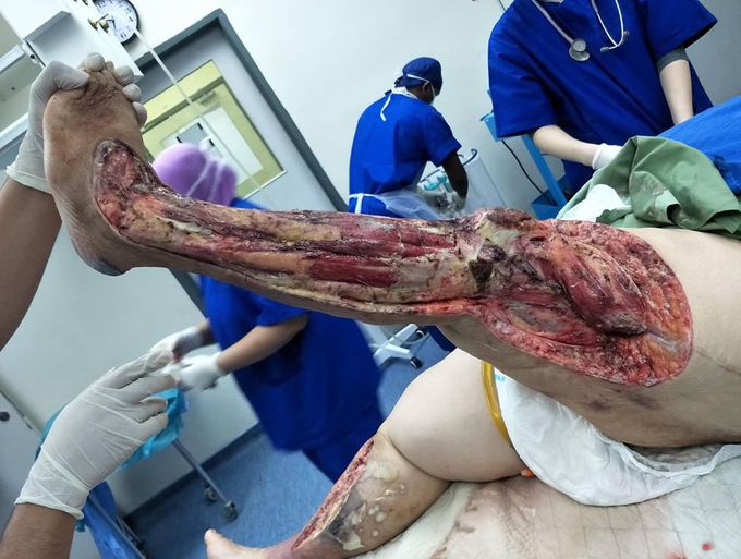 Case of billateral necrotizing fasciitis post debridement surgery showing muscle exposure. 