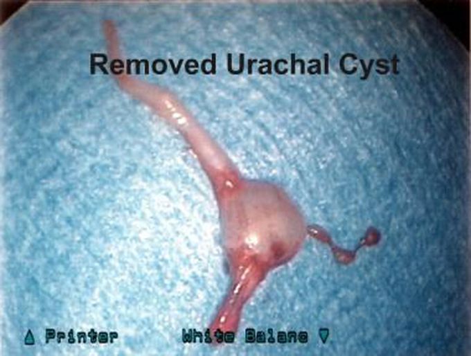 Photograph of laparoscopically removed urachal cyst and its attachments.