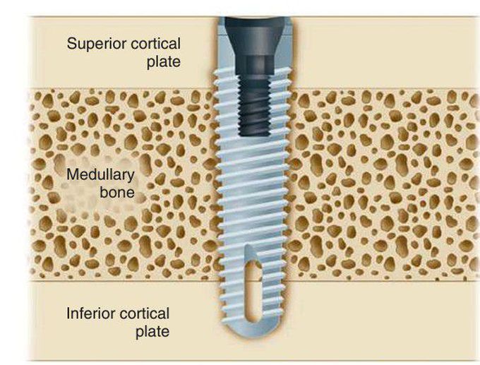 Dental implant