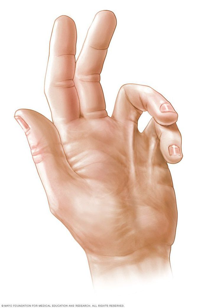 Dupuytren's Contracture