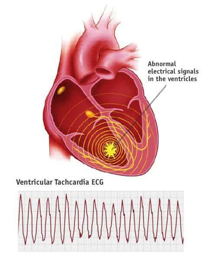 Ventricular Arrhythmia
