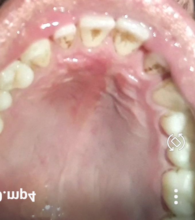 Rx ....hard palate