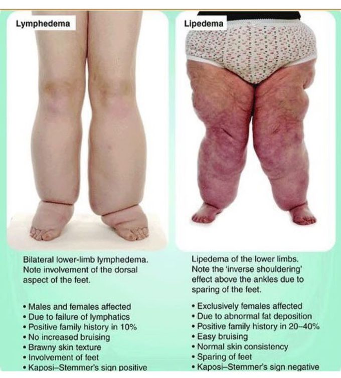 edema