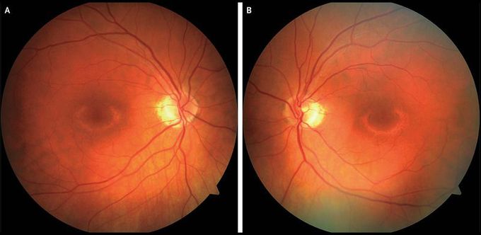 Bull’s-Eye Maculopathy Associated with Hydroxychloroquine