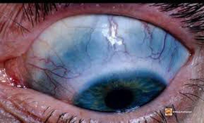 Causes of blue sclera