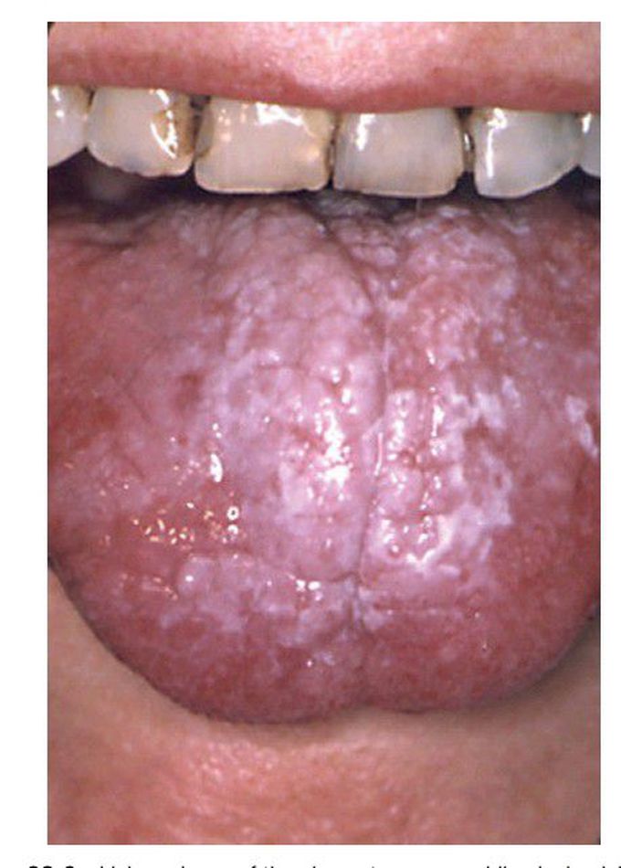 Types of lichen planus