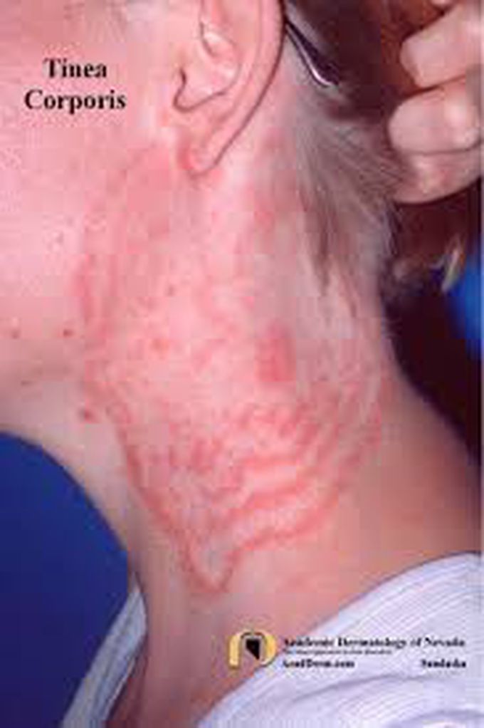 Tinea Corporis