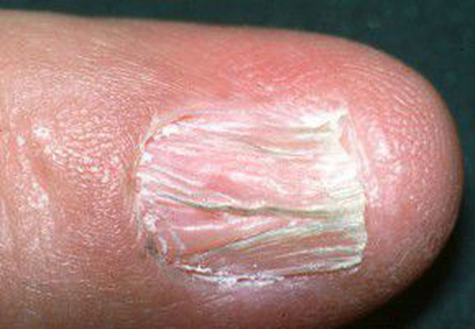 Lichen planus of the nail