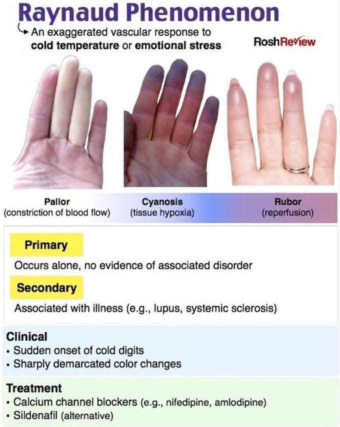 Raynaud's Phenomenon