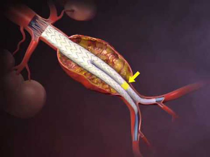 Abdominal Aortic Aneurysm-Graft
procedure