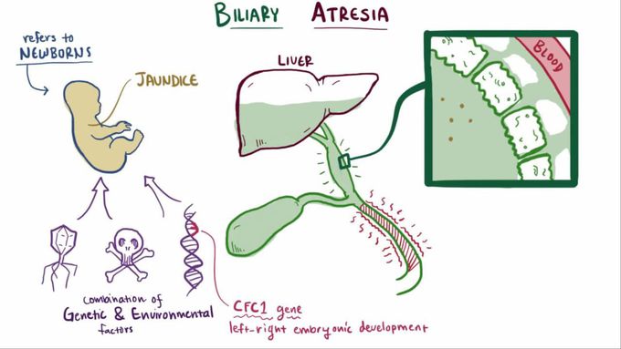Biliary atresia