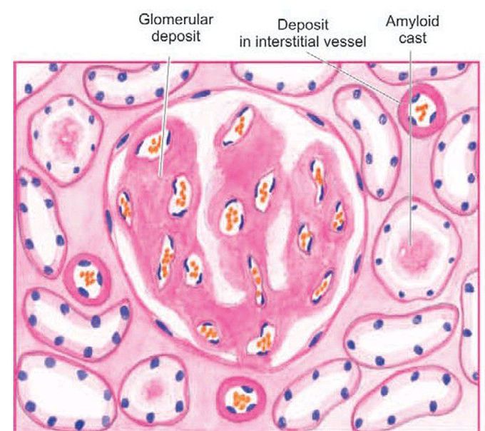 Amyloidosis of kidney.
