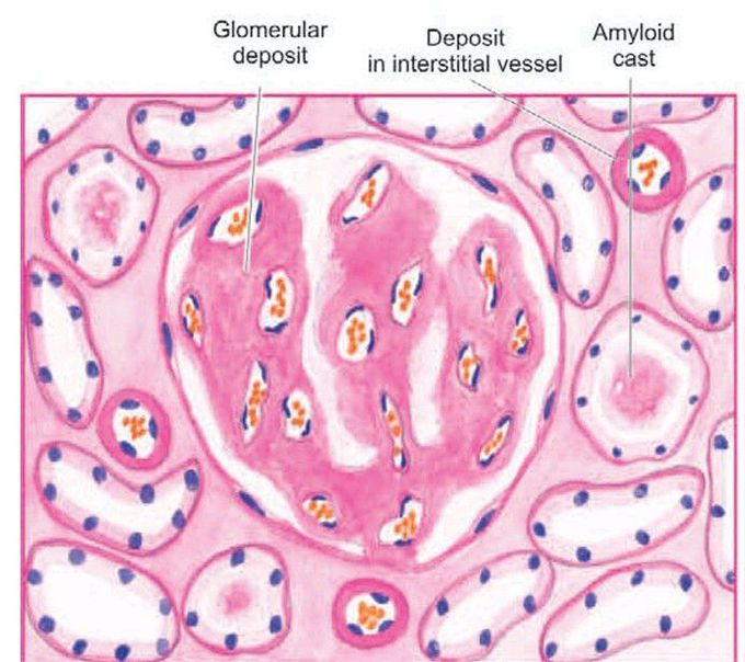 Amyloidosis of kidney.