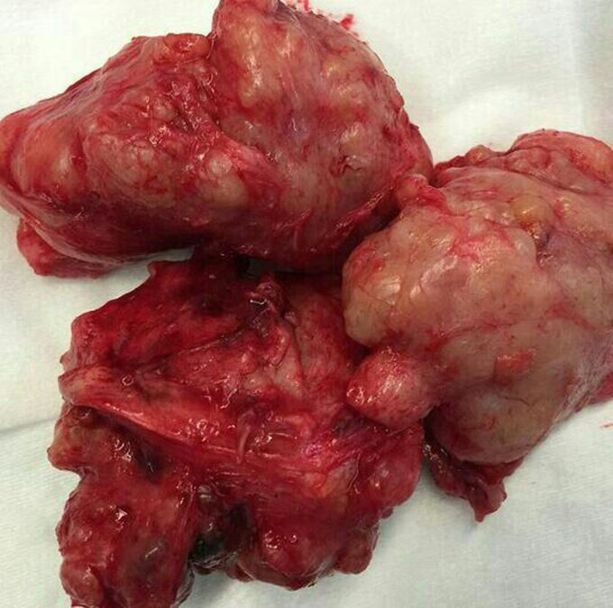 Prostatic  cancer