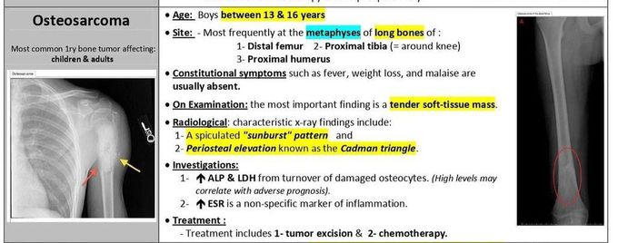 Osteosarcoma