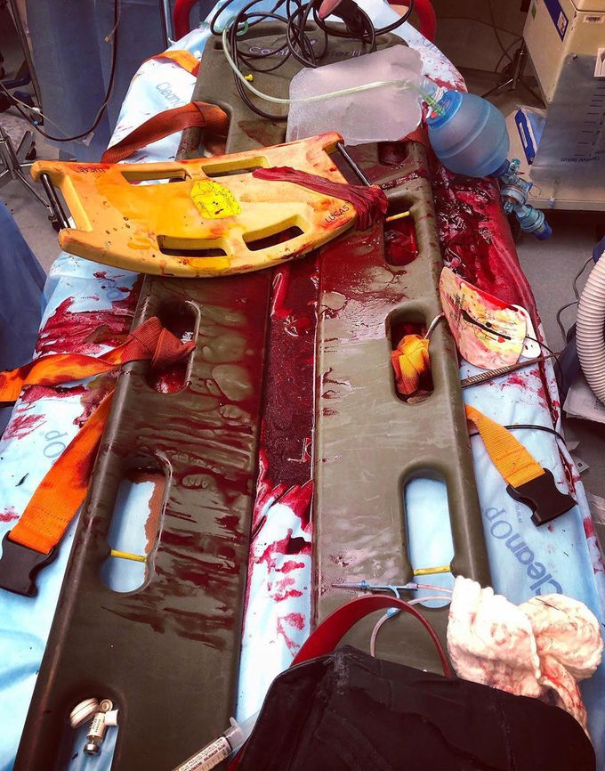 Powerful image of an aftermath of a gunshot wound to chest!