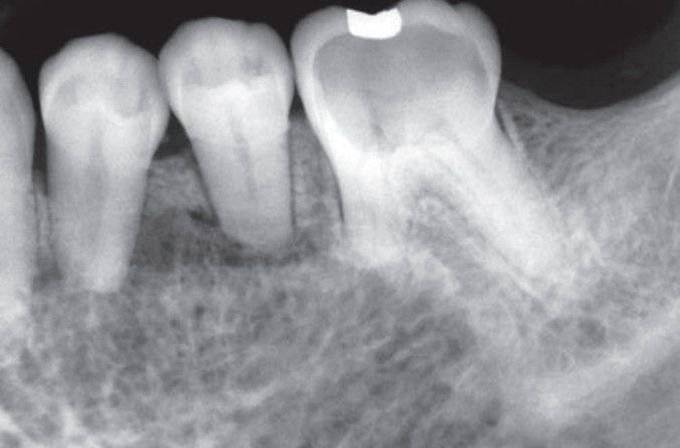 Hemangioma of alveolar bone