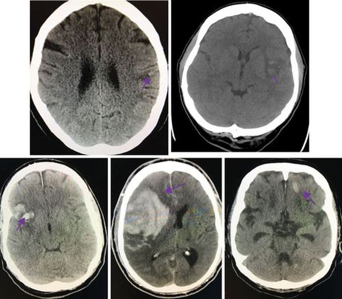 Absolute Contraindications of tPA Therapy for Stroke