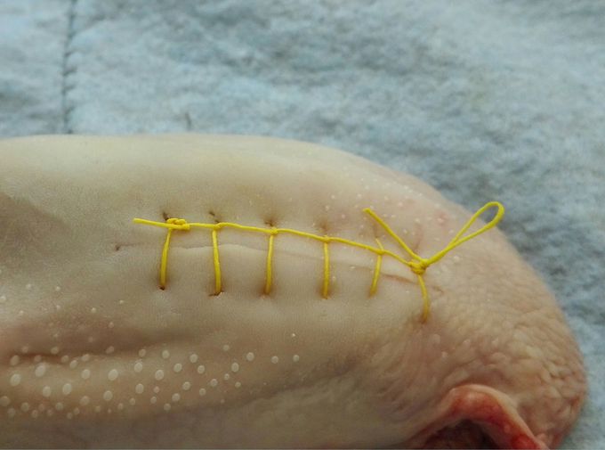 Suture reverdin