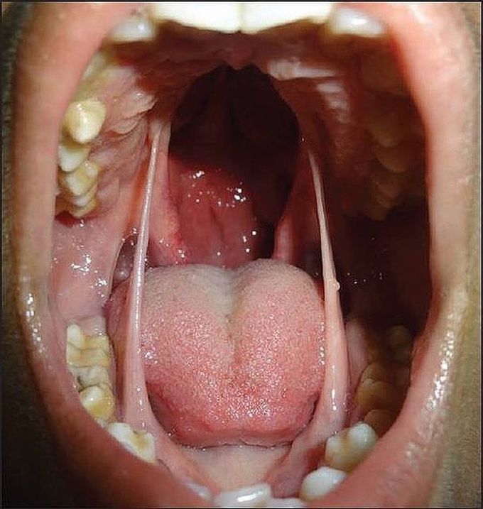 A Case Study of Cleft Palate