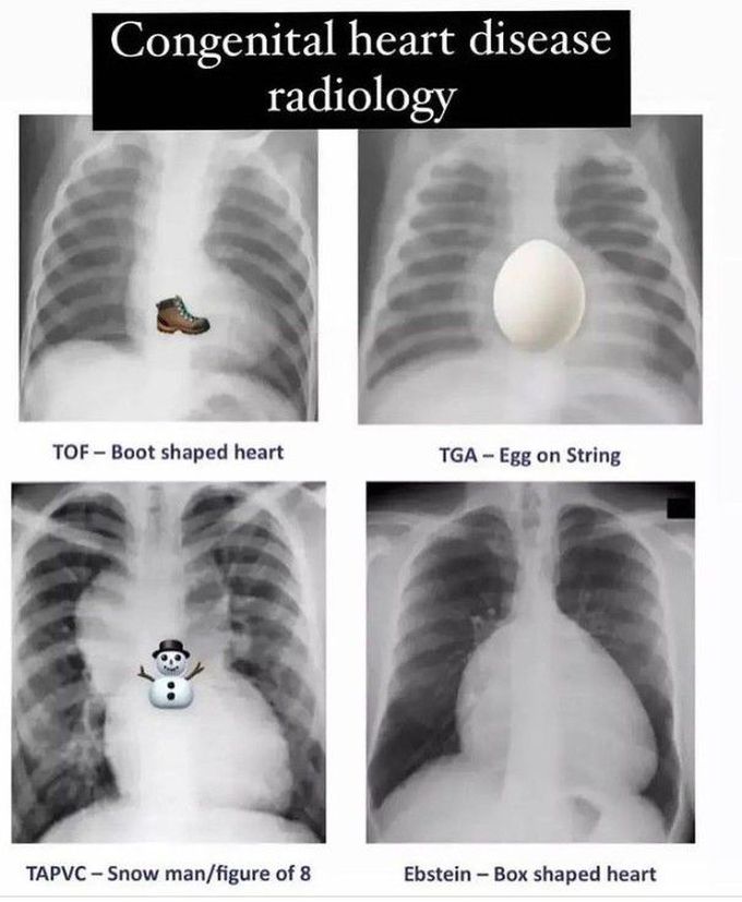 Congenital Heart Disease Xray