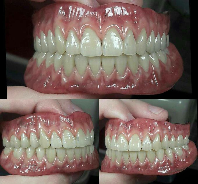 One more Smile is Retained ( Complete Denture )