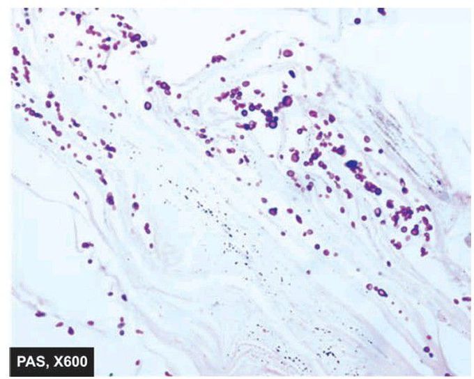 Tinea capitis in the skin.