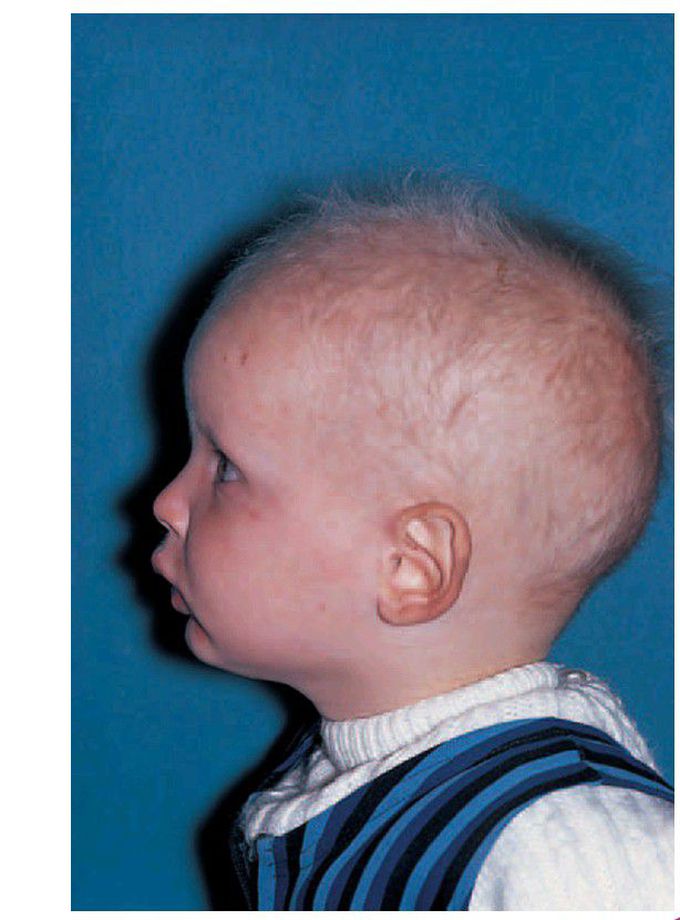Hereditary ectodermal dysplasia