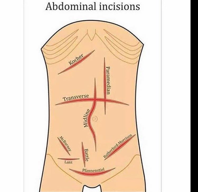 Abdominal incisions