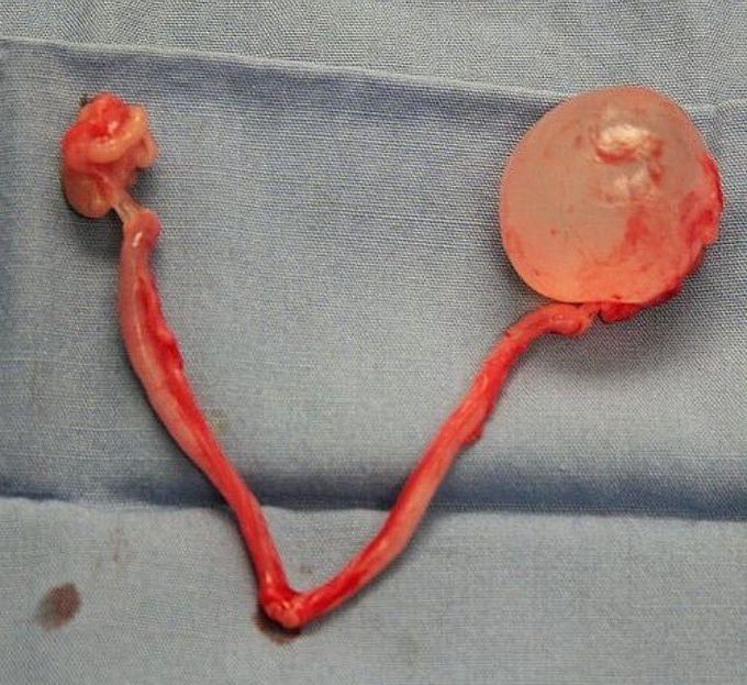 A fluid-filled ovarian cyst