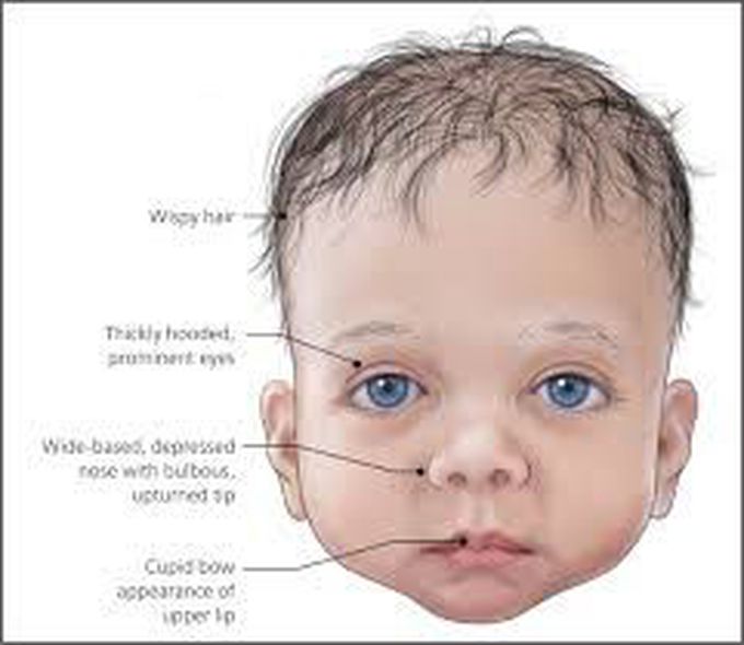 What is Noonan's syndrome