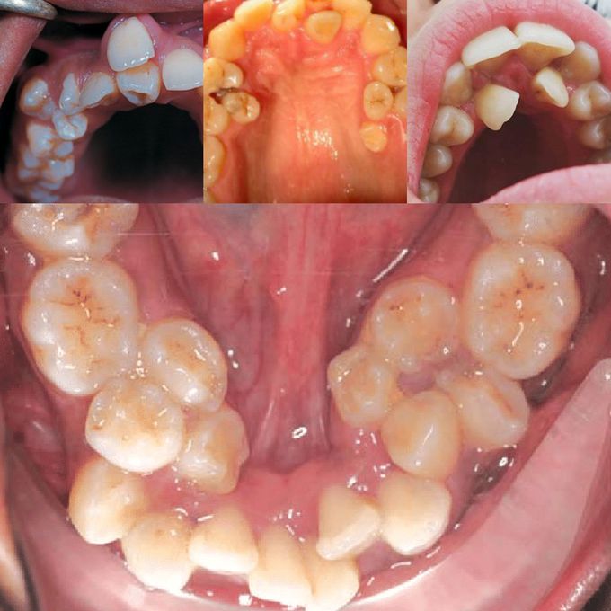 Hyperdontia