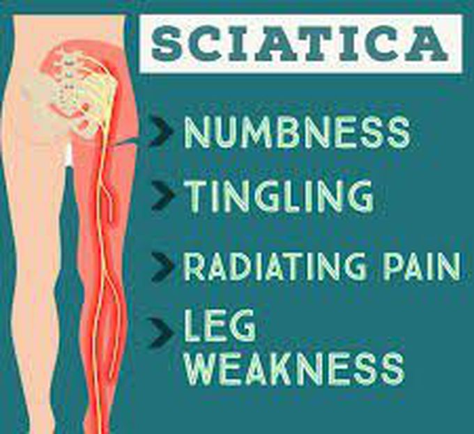Symptoms of sciatica