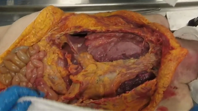 Pic taken during body autopsy