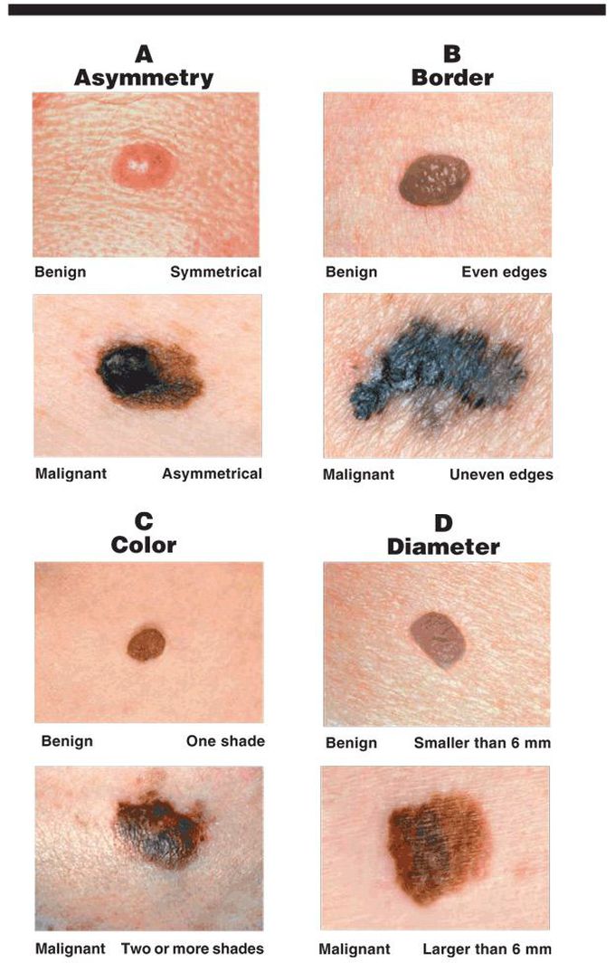 Characteristics of cancerous moles