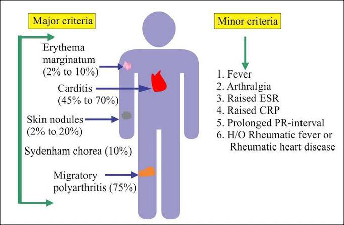 Rheumatic fever