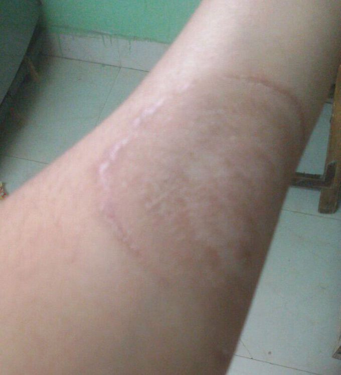 Skin disease 
