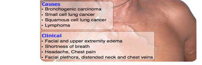 These are the causes and clinical features of superior vena cava syndrome