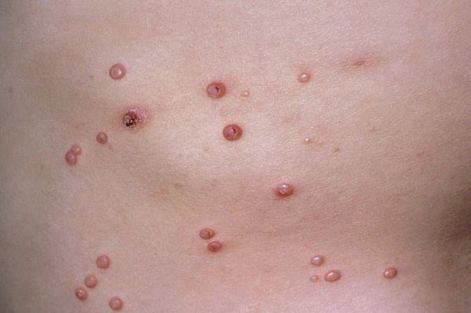 Causes of molluscum contagiosum