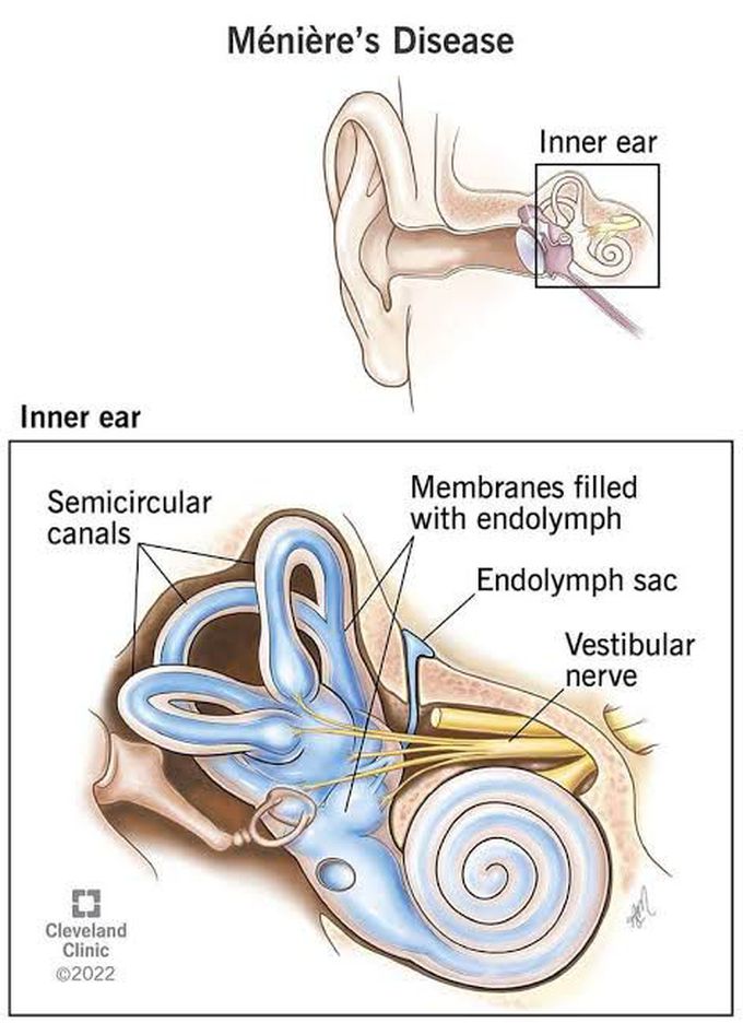 Menieres disease causes