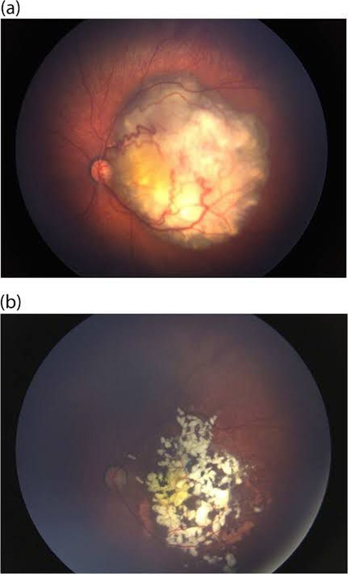 Retinoblastom affected eye