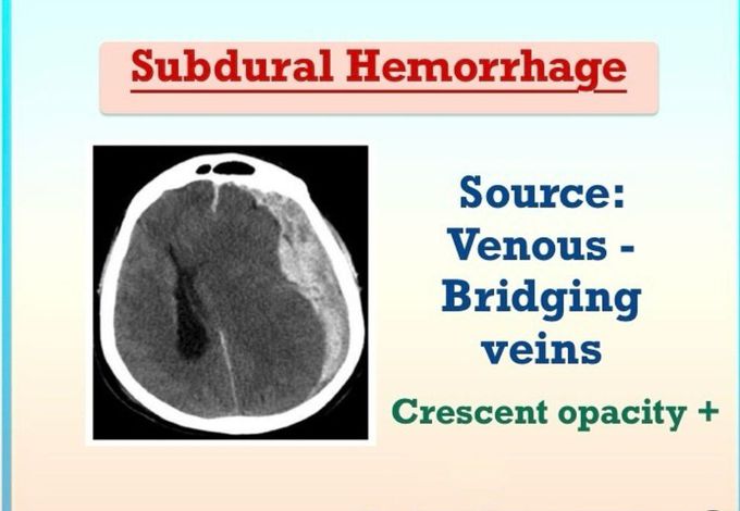 Subdural Hemorrhage