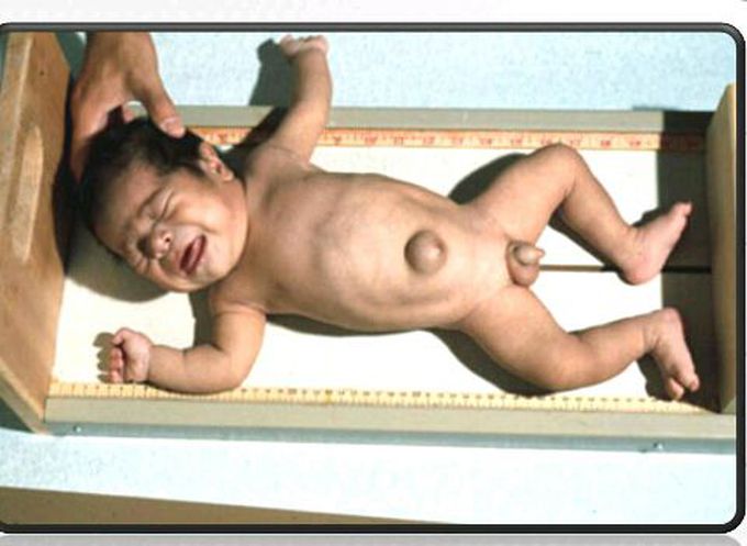 Congenital Hypothyroidism