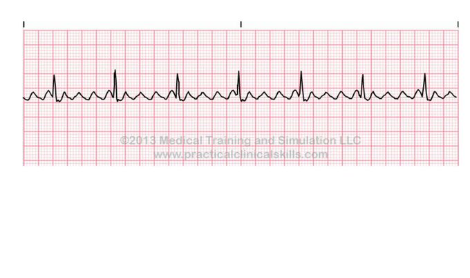 ECG interpretation
