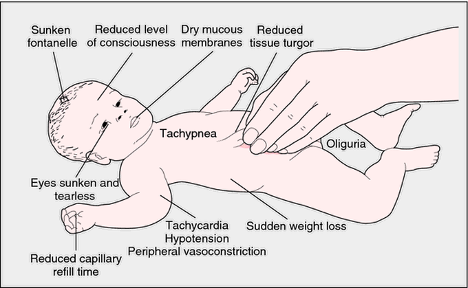 signs of dehydration in babies