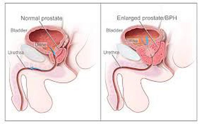 Treatment for benign prostatic hyperplasia