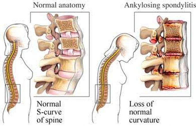 Spondylitis