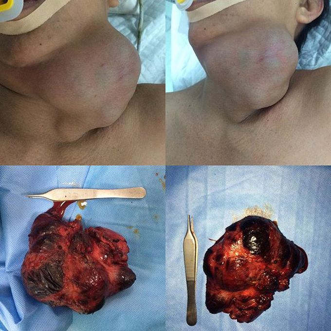 Thyroid cyst